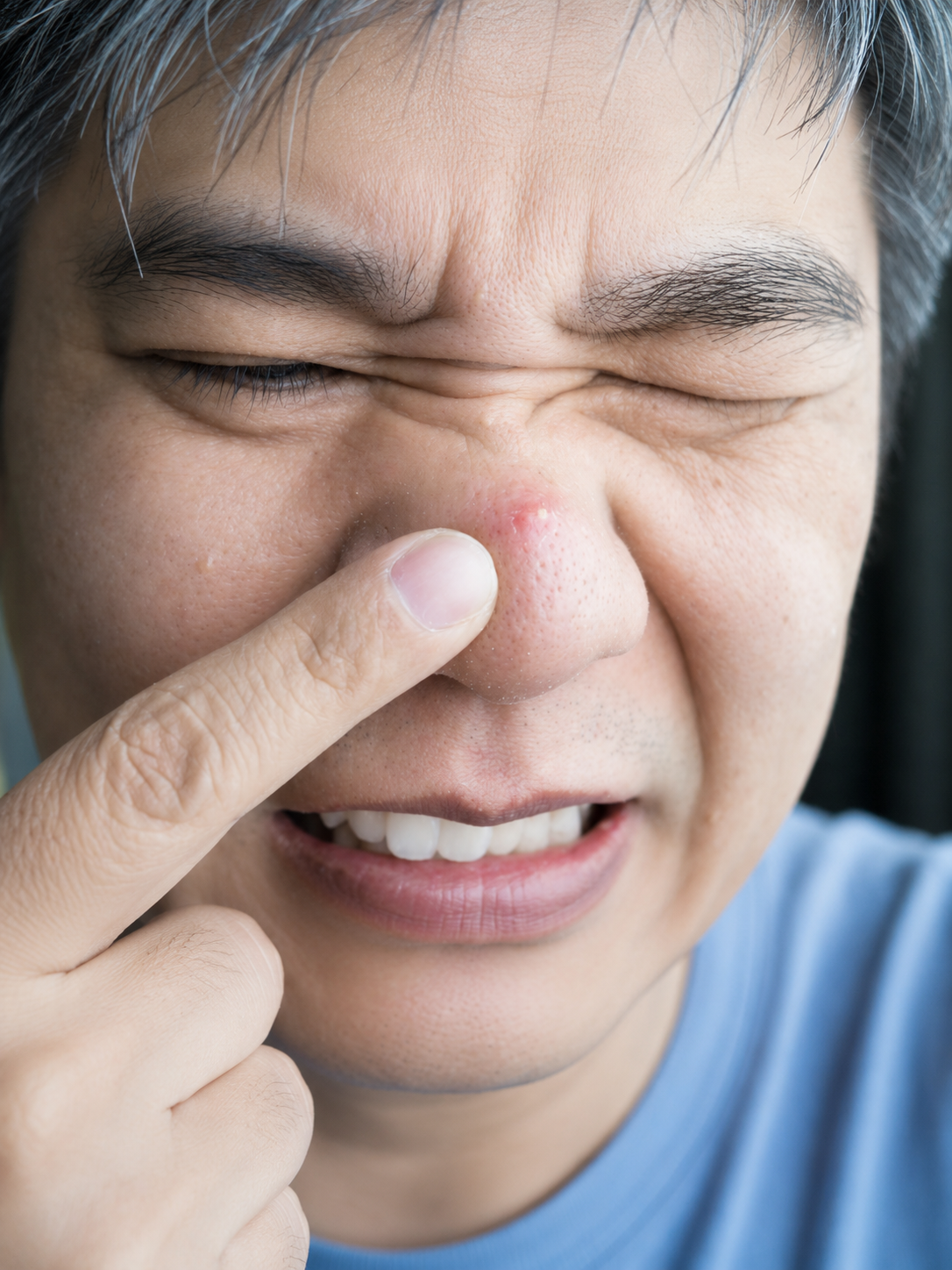 Why Do Pores Look Bigger After Blackhead Removal?